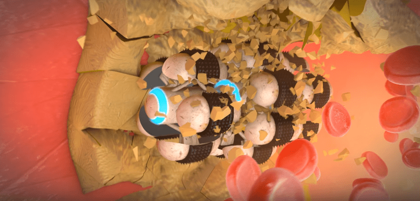 Atherosclerosis plaque extraction scientific animation