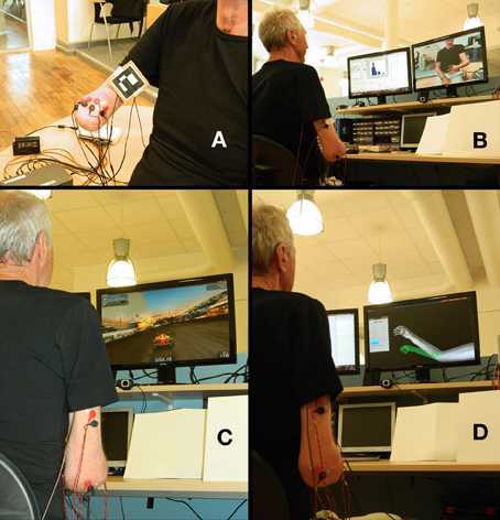 phantom limb pain