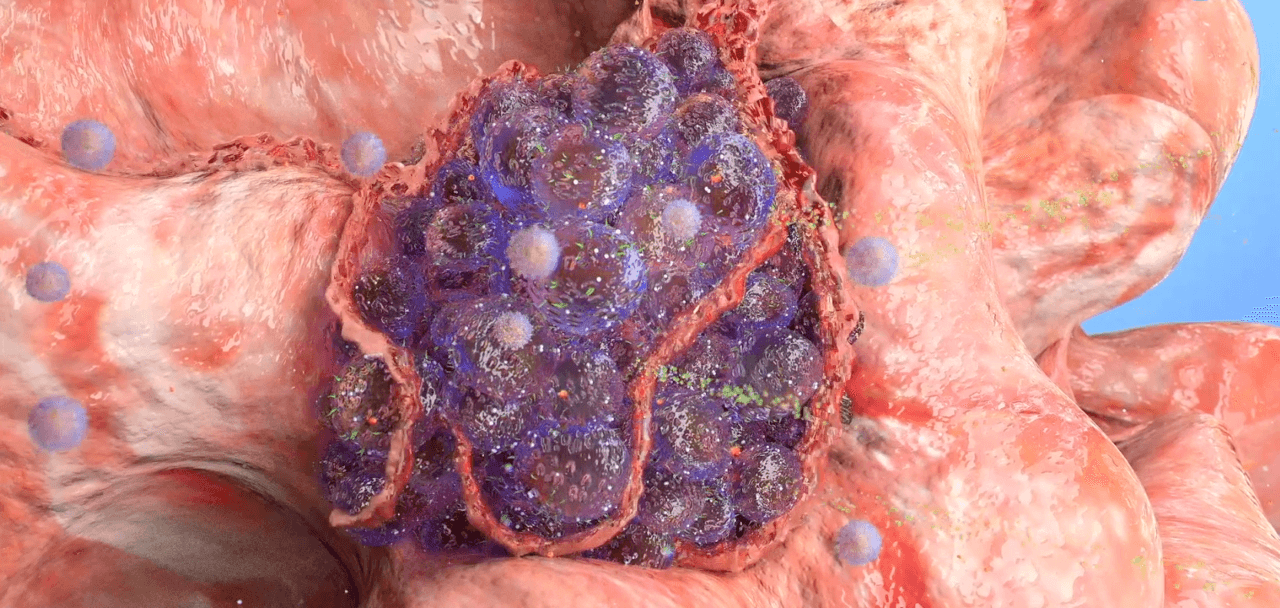 Cancer development medical video