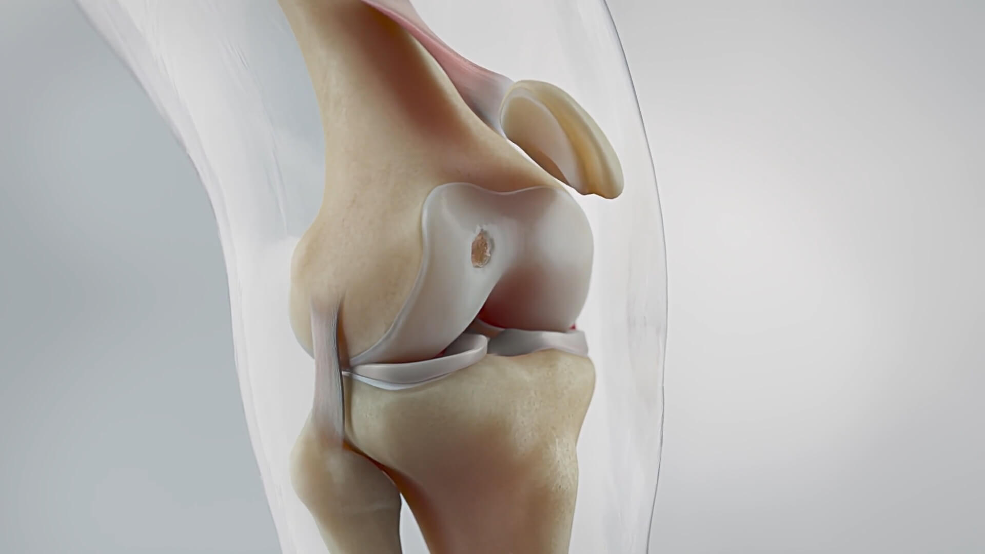 3D animation explaining the process of developing artificial joints