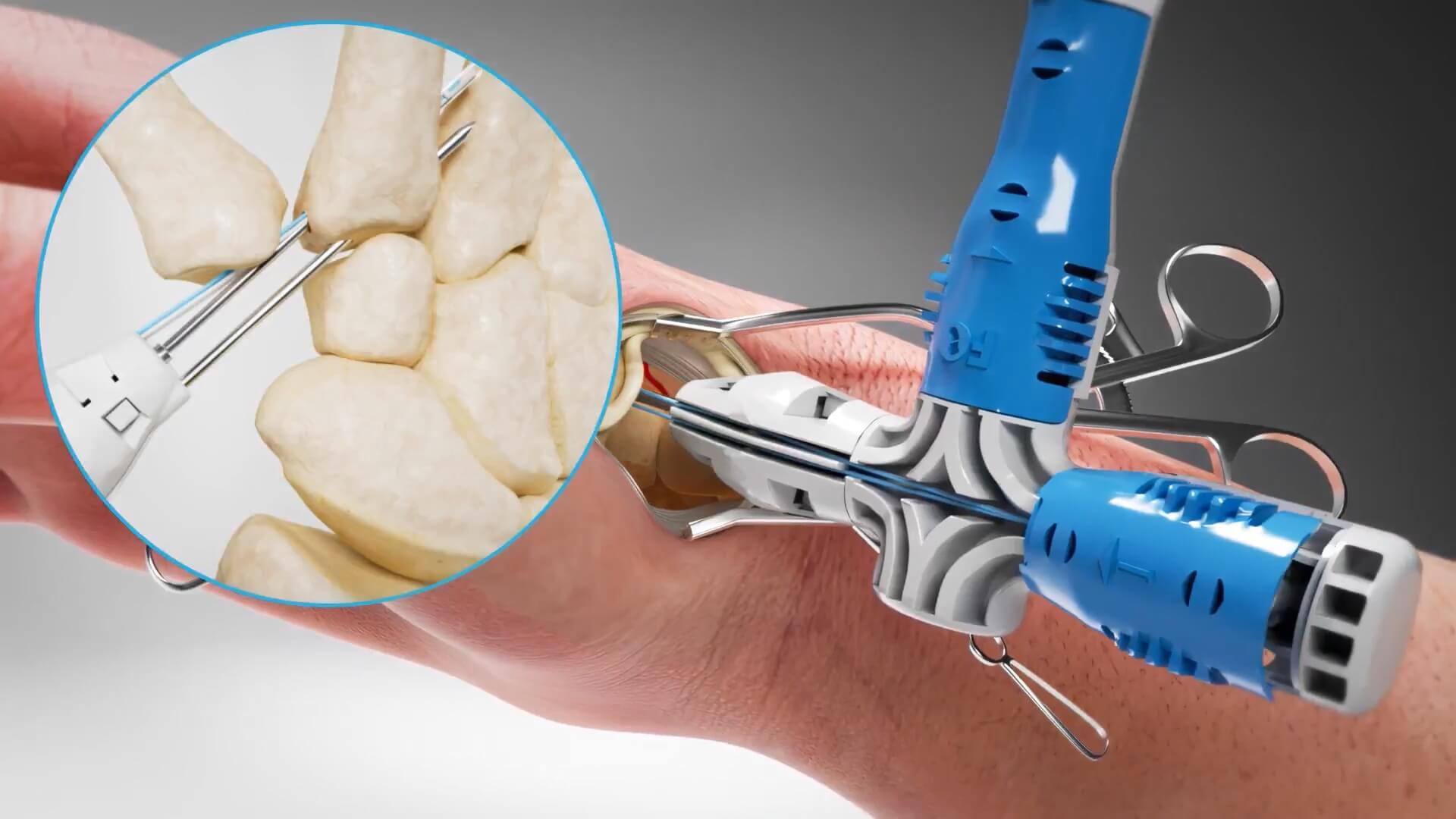 Field Orthopaedics - 3D animation of surgical technique